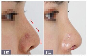 ?？诩袤w隆鼻.jpg