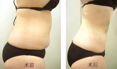 腹部吸脂——?jiǎng)⑴? /></a></div>
                        <span><h1><a href=