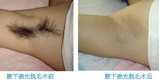腋下激光脫毛術(shù)——?jiǎng)⑾壬? /></a></div>
                        <span><h1><a href=