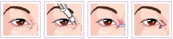開眼角
